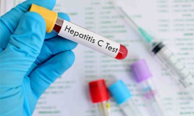 Hepatitis en Argentina