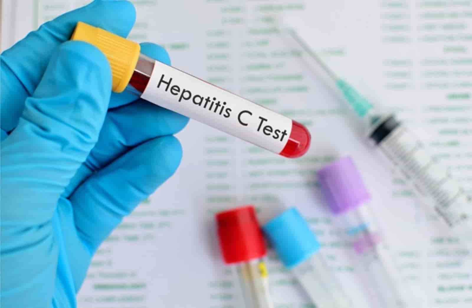 Hepatitis en Argentina
