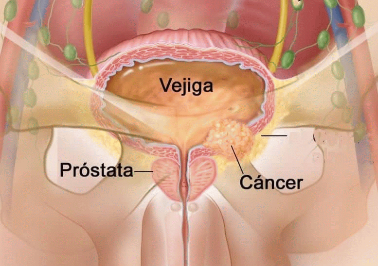 El 5 de Mayo Día internacional del Cáncer de Vejiga